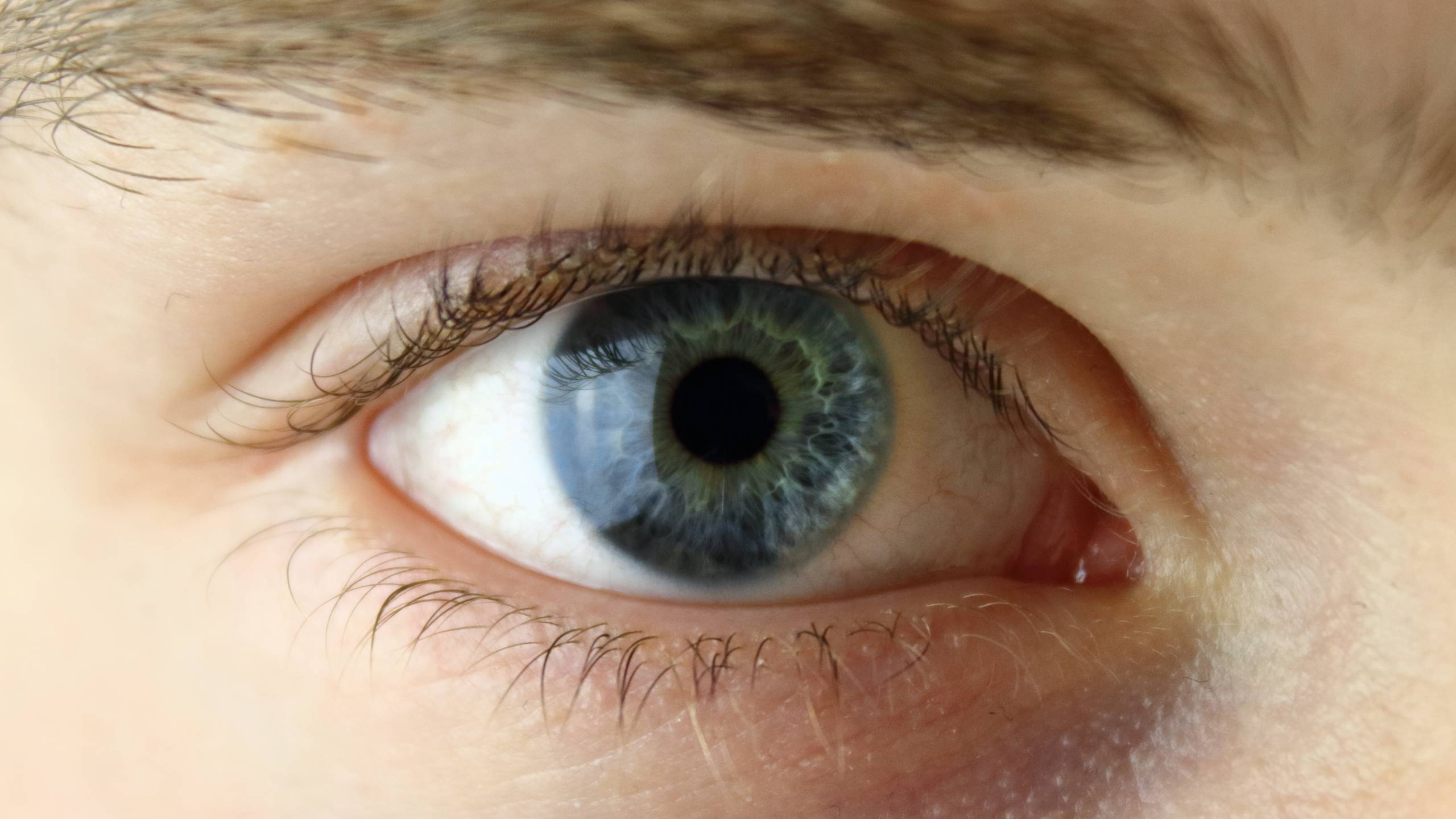 Ocular Herpes Can Be Treated But Not Prevented With A Vaccine 