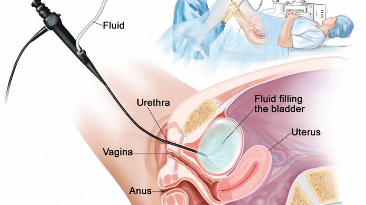 bladder cancer